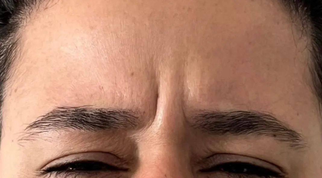 Antes da aplicação de toxina botulínica na glabela