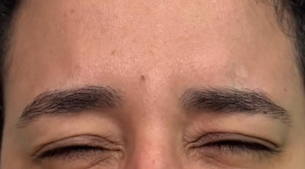 Depois da aplicação de toxina botulínica na glabela