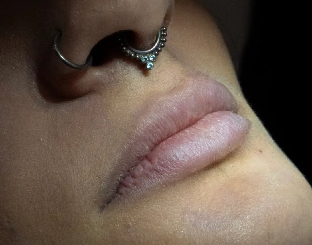 Antes do preenchimento labial