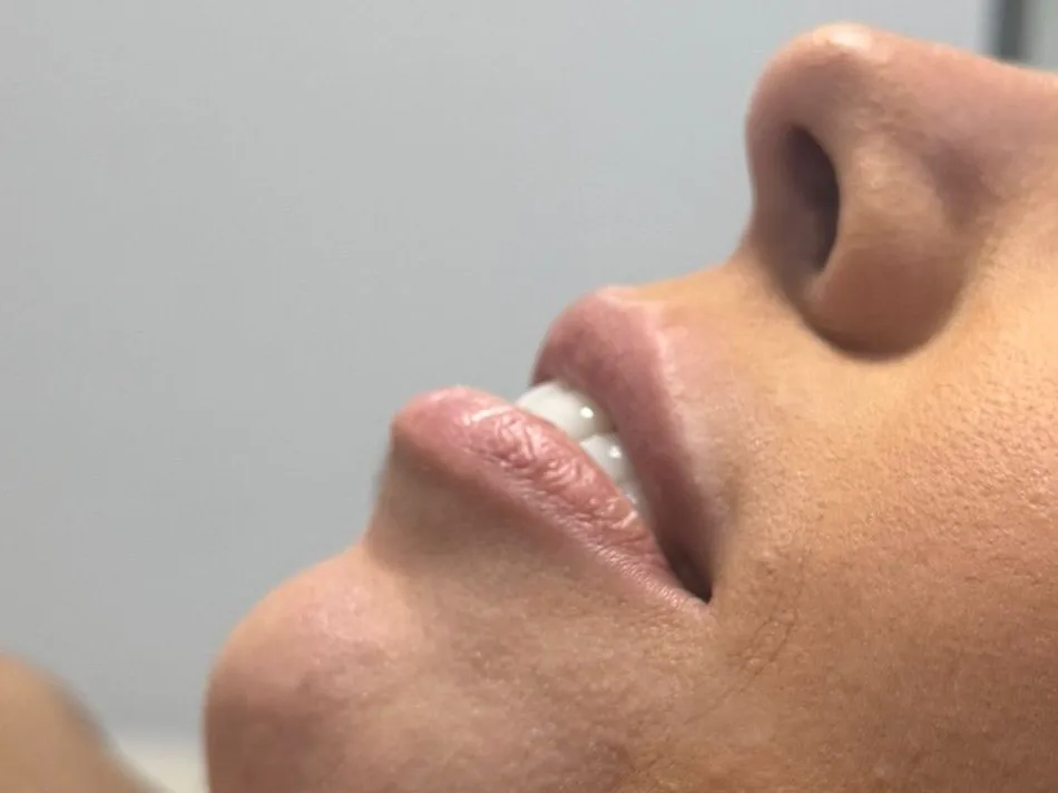 Antes do preenchimento labial