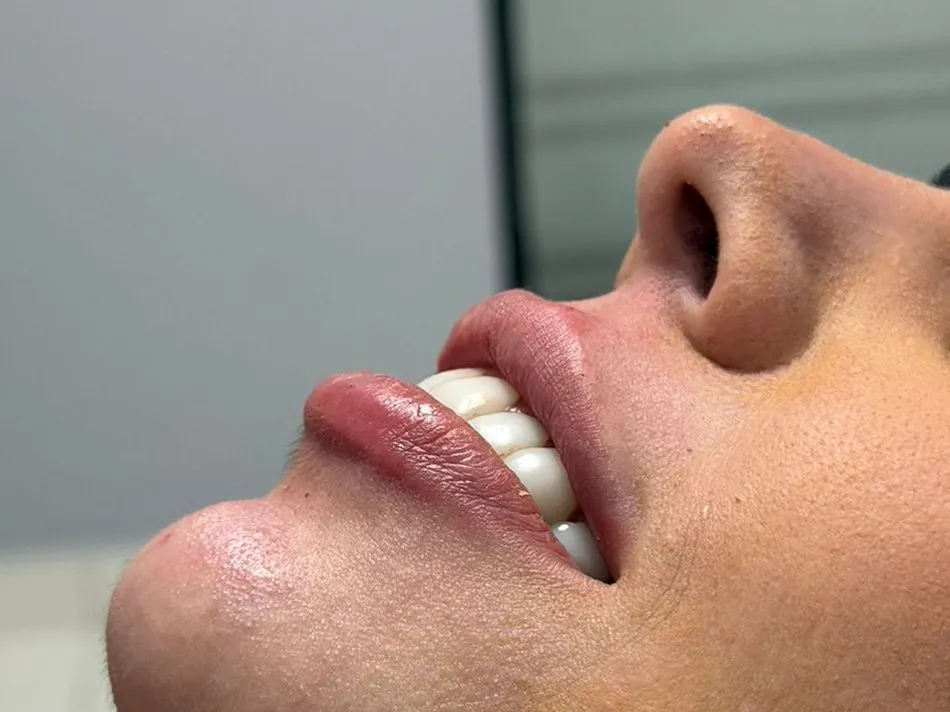 Depois do preenchimento labial