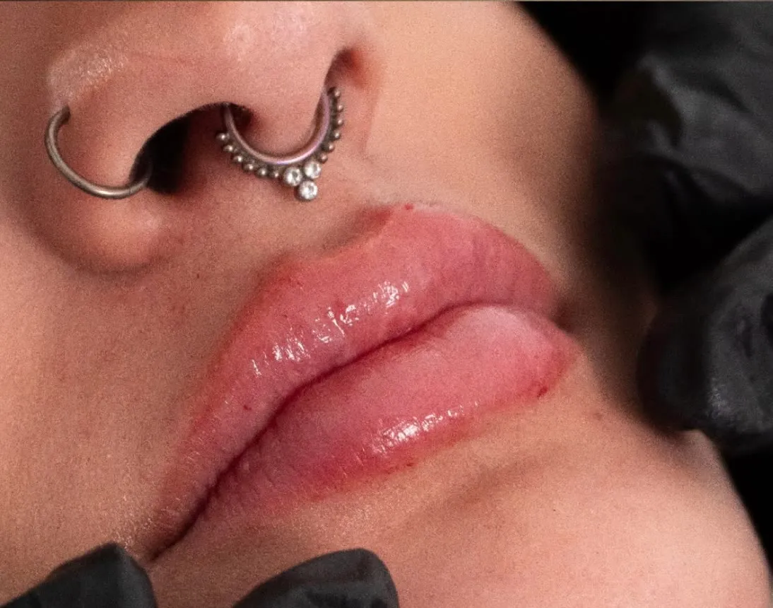 Depois do preenchimento labial